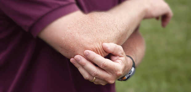 Osteoarthritis Relief