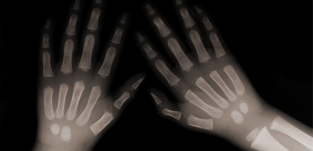 Bone Up on Bone Disease